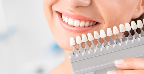 Is professional teeth whitening for you? 646f8be7319cf.jpeg