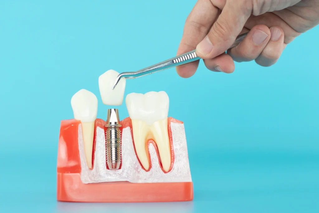 dental implants near me
